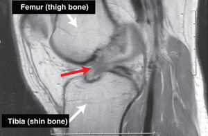 ACL tear on MRI scan